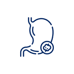 Stomach (Gastric) Cancer Surgery